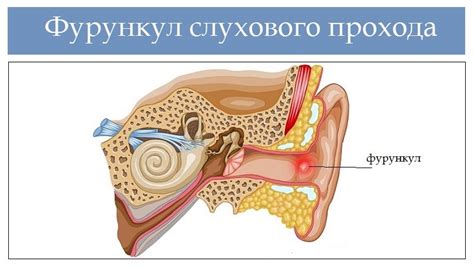 Причины образования сернистых отложений в слуховом канале