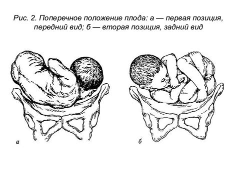 Причины предположения продольного расположения головного плода