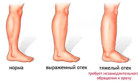 Причины усталости ног в период высоких температур