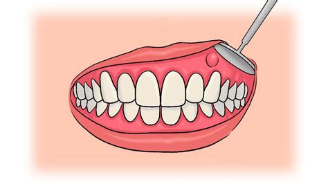 Профилактика гнойного мешка на десне