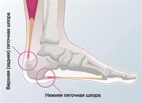 Пятка болит: варианты лечения и профилактика