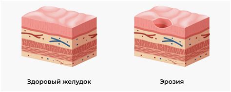 Раздражение слизистой оболочки и его последствия