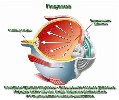 Разновидности глаукомы: открытоугольная, закрытоугольная