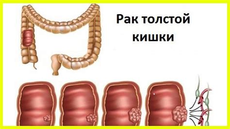 Рак толстой кишки: серьезное заболевание, которое необходимо исключить