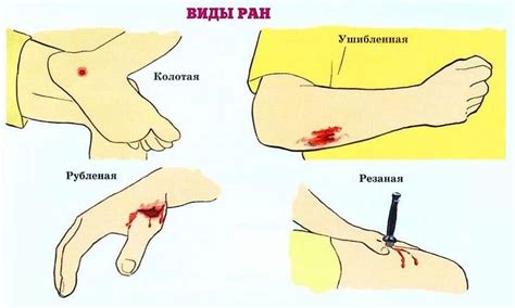 Риск растяжения раны