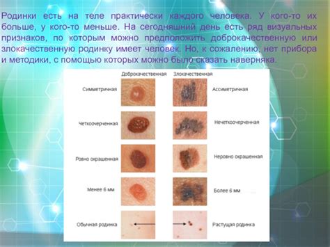 Родинки как индикатор врожденных пигментных проявлений