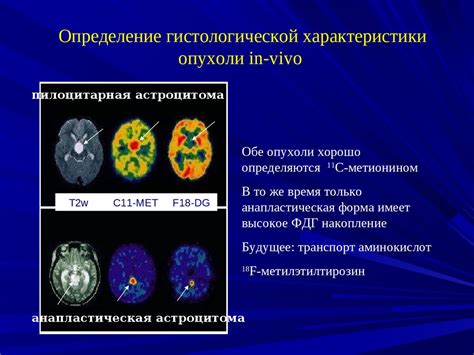 Роль ПЭТ в онкологии и неврологии