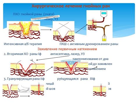 Роль локального лечения в быстром восстановлении послеоперационной раны