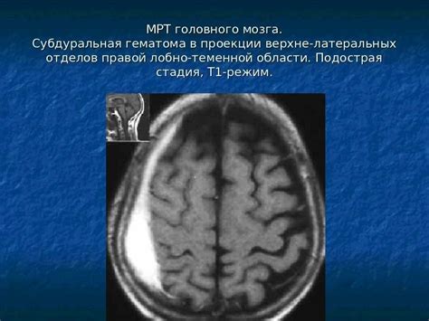 Роль симметрии и дисбаланса в развитии латеральных камер мозга