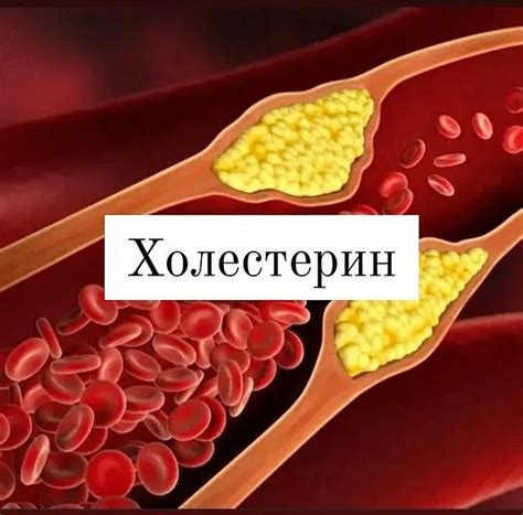 Связь гликированного холестерина с сердечно-сосудистыми заболеваниями