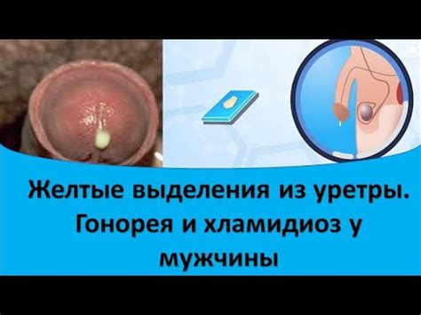 Симптомы, сопровождающие желтые и густые выделения