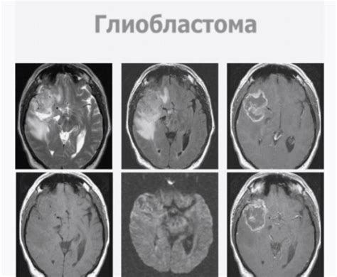 Симптомы глиозных очагов головного мозга