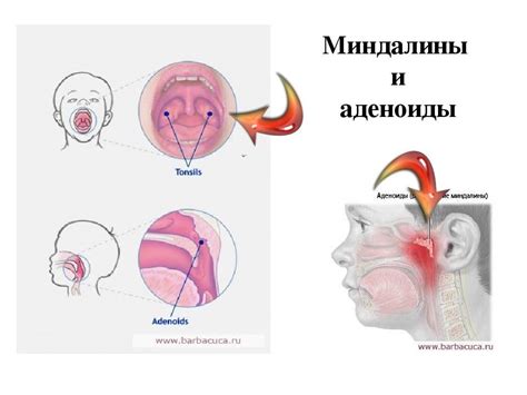 Симптомы заболеваний гланд и аденоидов