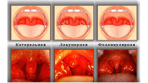 Симптомы и последствия неприятного состояния миндалин