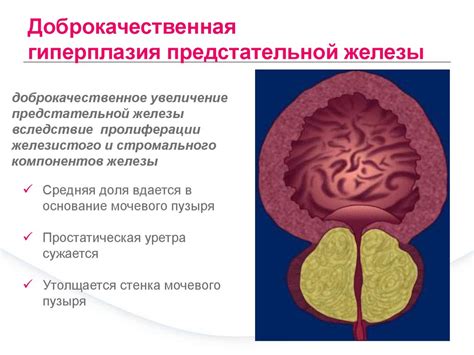 Симптомы и признаки нервной инвазии при онкологическом поражении предстательной железы