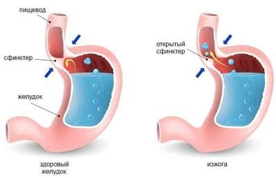 Симптомы и факторы, вызывающие изжогу