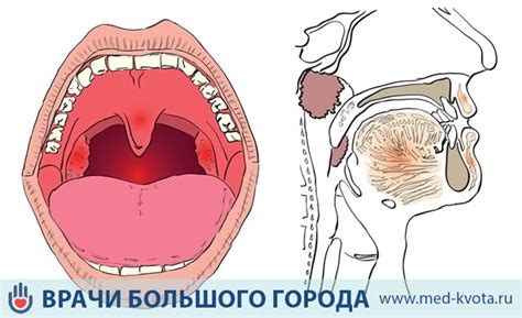 Симптомы порванных голосовых связок