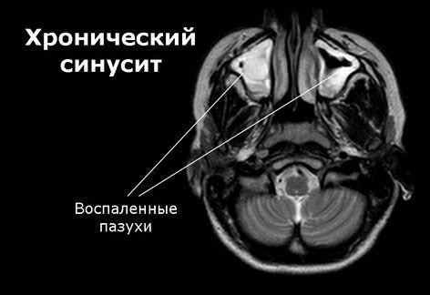 Синусит: основные причины