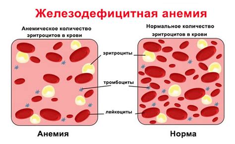 Скрытый угроза: железодефицитная анемия и ее влияние на организм