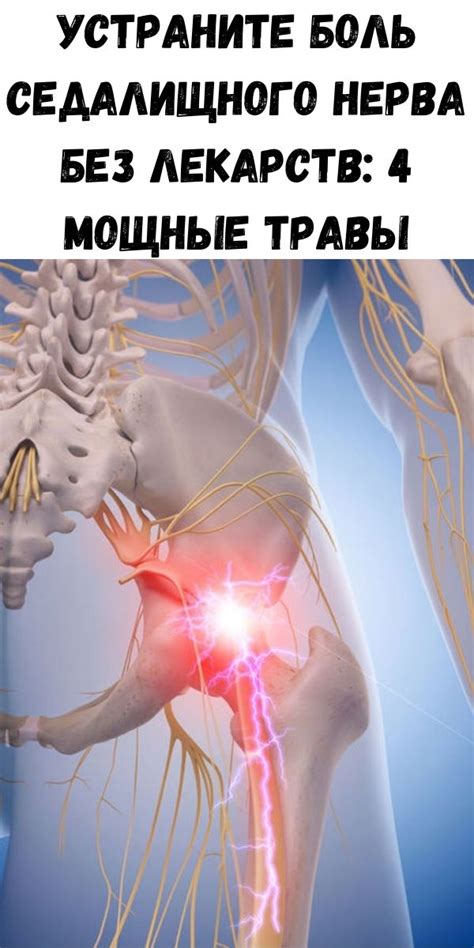 Способы снятия боли при сдавливании седалищного нерва без применения лекарств
