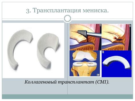 Трансплантация мениска: перспективная техника восстановления функций коленного сустава