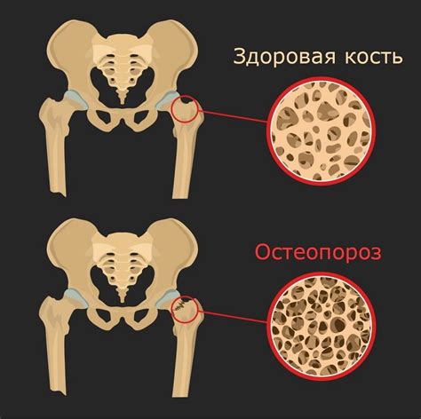 Укрепление костной ткани и профилактика остеопороза