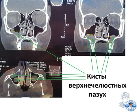 Факторы, влияющие на сокращение объема воздушного пространства правой верхнечелюстной пазухи