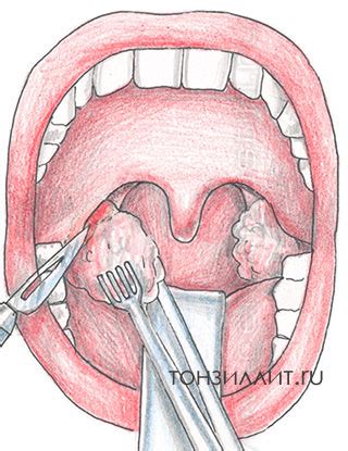 Хирургическое вмешательство при гипертрофии глоточных миндалин у детей