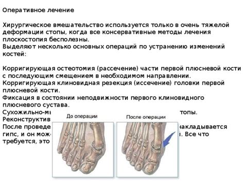 Хирургическое вмешательство при деформации пятки: основные этапы и рекомендации