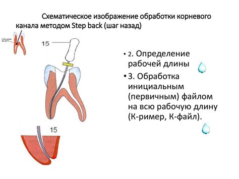 Шаг 3: Упрочение корневого аппарата для сохранения его структуры